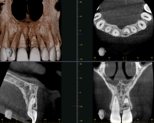 four x-rays of different teeth and parts of the jaw